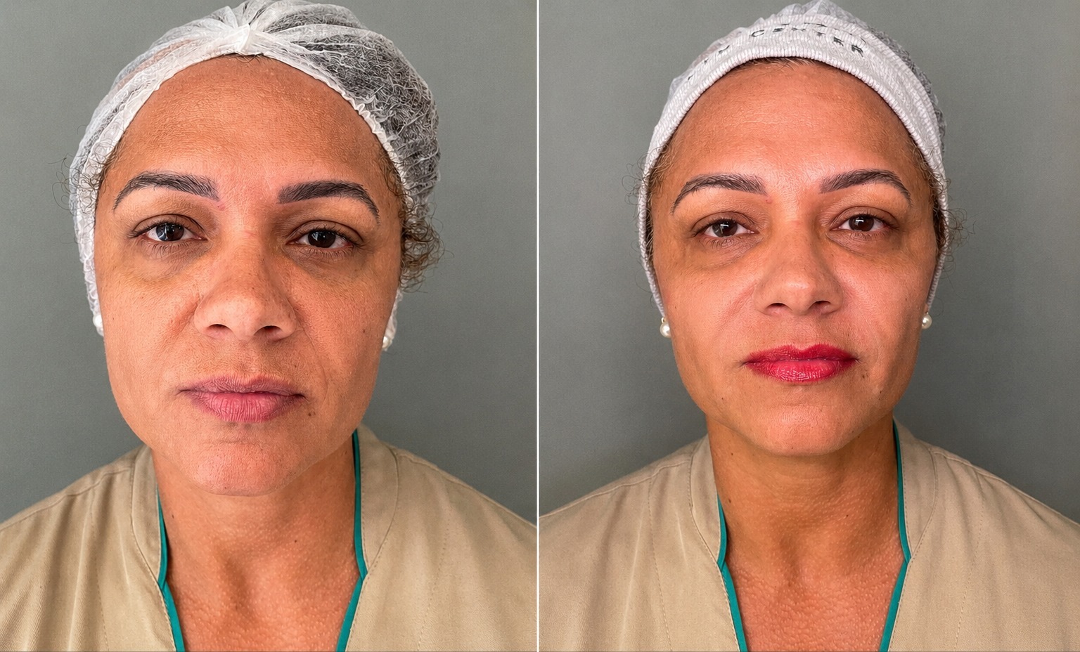 Depois da harmonização facial